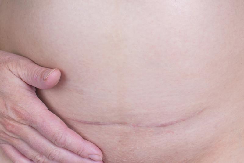 15_things_you_wish_you_knew_before_a_c_section_the_incision_wound_babyinfo