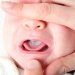 Oral Thrush in Babies: Signs, Treatment and Prevention