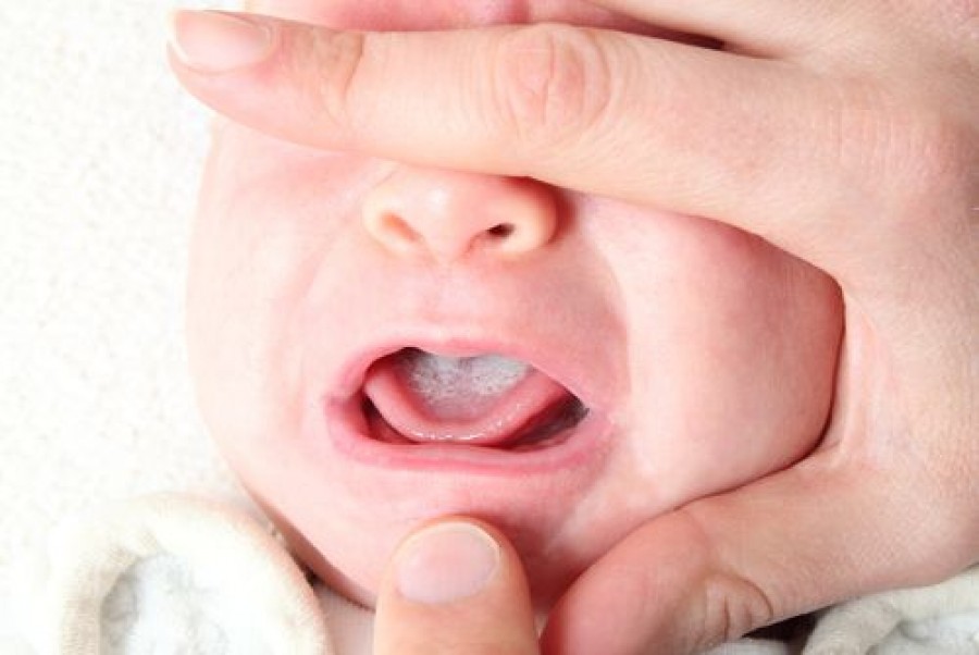 Oral Thrush in Babies: Signs, Treatment and Prevention