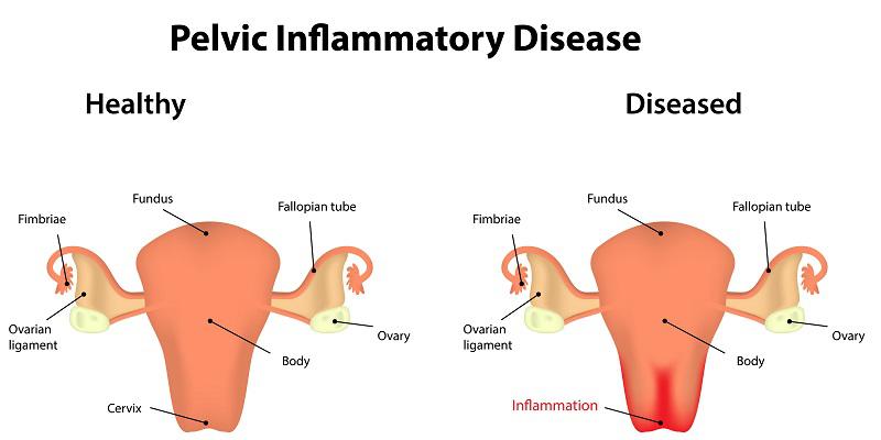 Pelvic_Inflammatory_Disease