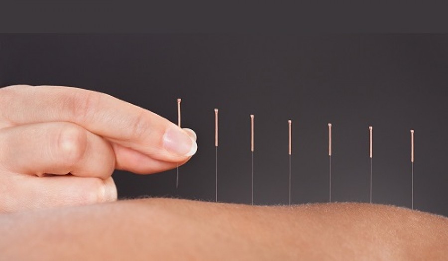 What You Need to Know About Acupuncture for Fertility