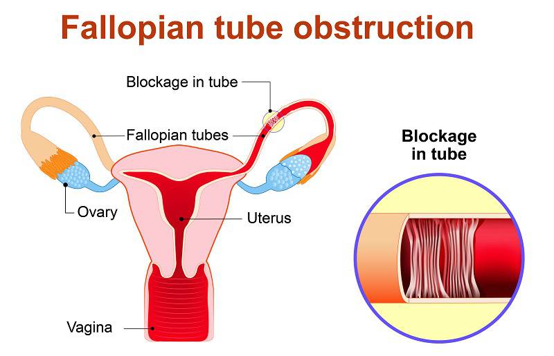 blockage_of_the_fallopian_tubes
