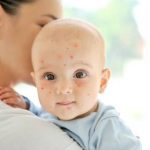 Chickenpox in Babies: Definition, Symptoms and Care